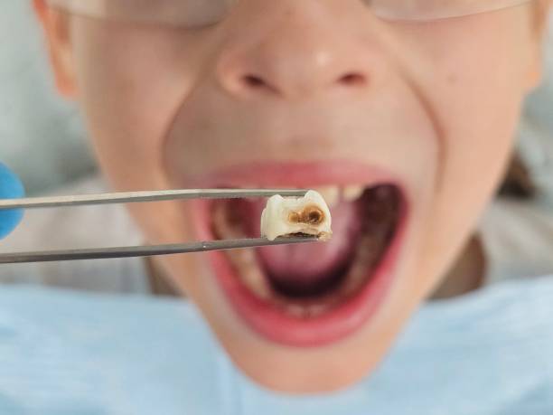 Best Pediatric Emergency Dentist in Cassville, WV