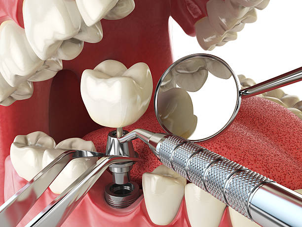 Best Emergency Tooth Extraction in Cassville, WV
