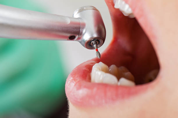 Best Emergency Wisdom Teeth Removal in Cassville, WV